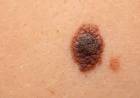 Argentina desarrolló la primera vacuna terapéutica con el melanoma 